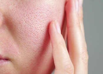 Jak wygląda trądzik różowaty? Poznaj objawy, przyczyny i sposoby leczenia