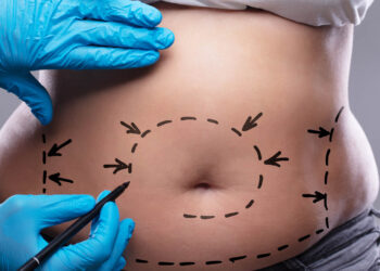 Kiedy plastyka brzucha jest dobrym wyborem?