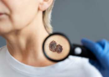 Laserowe usuwanie pieprzyków Warszawa. Jak nowoczesne technologie przyczyniają się do zdrowszej i piękniejszej skóry